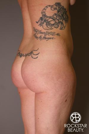 Brazilian Butt Lift: Patient 7 - Before Image 2