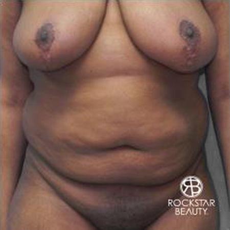 Tummy Tuck: Patient 9 - Before 1