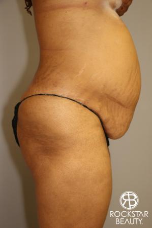 Tummy Tuck: Patient 3 - Before Image 3