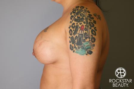 Breast Implant Exchange: Patient 1 - Before Image 4