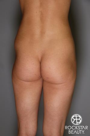 Butt Augmentation: Patient 3 - Before Image 1