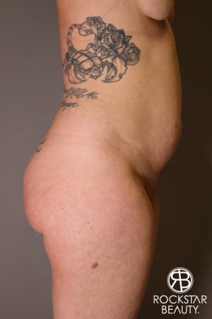 Brazilian Butt Lift: Patient 7 - Before Image 3
