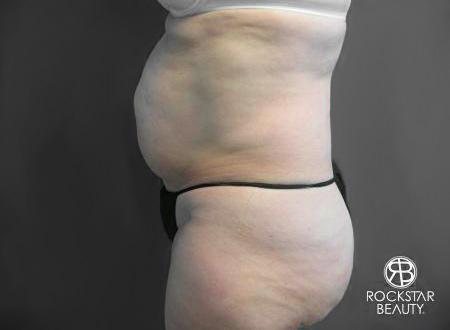 Tummy Tuck: Patient 6 - Before and After 4