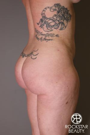 Brazilian Butt Lift: Patient 7 - After Image 2