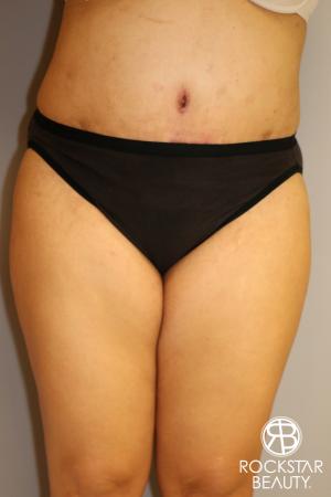 Tummy Tuck: Patient 2 - After Image 1
