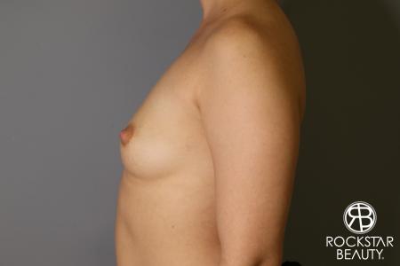 Breast Augmentation: Patient 16 - Before Image 4