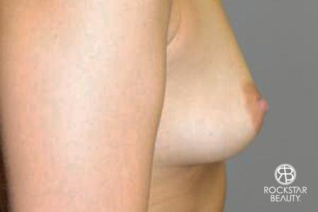 Breast Augmentation - Fat: Patient 1 - Before and After Image 3