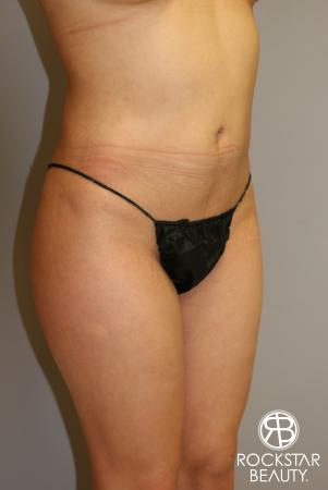 Liposuction: Patient 14 - Before Image 3