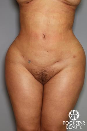 Brazilian Butt Lift: Patient 14 - After Image 2
