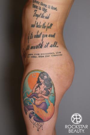 Brazilian Butt Lift: Patient 17 - After Image 5