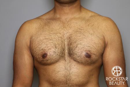 Liposuction: Patient 16 - Before Image 3
