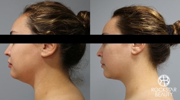 Liposuction Of The Neck: Patient 8 - Before and After  