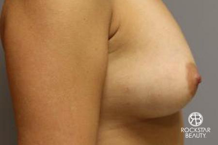 Breast Augmentation - Fat: Patient 1 - After Image 3