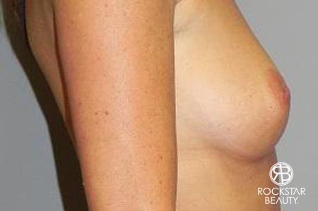 Breast Augmentation: Patient 5 - Before and After 3