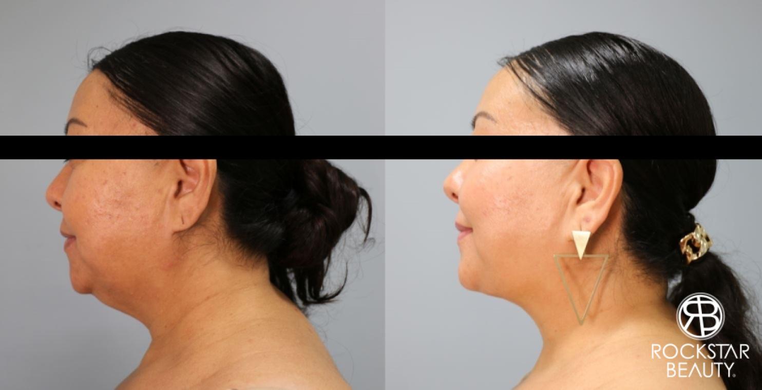 Liposuction Of The Neck: Patient 80 - Before and After 1