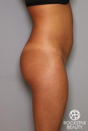 Brazilian Butt Lift: Patient 9 - Before Image 2