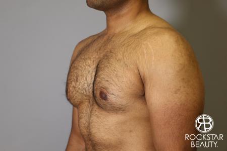Liposuction: Patient 16 - Before Image 2