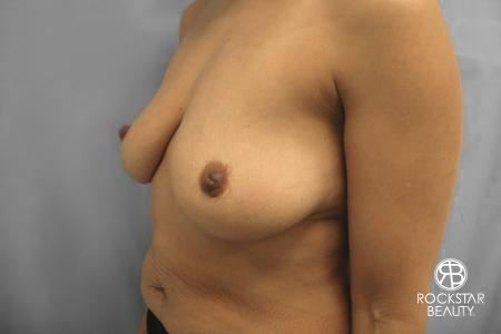 Combo Procedures - Breast: Patient 1 - Before 4
