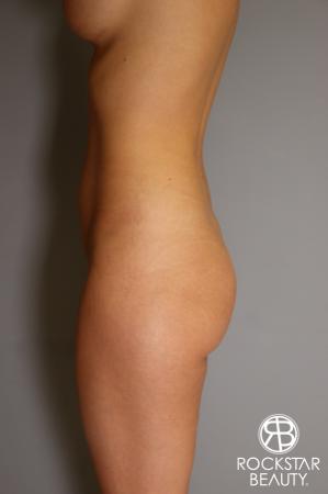 Brazilian Butt Lift: Patient 2 - Before Image 2