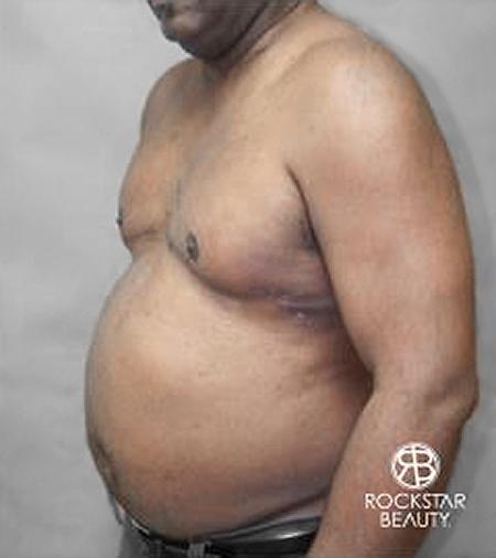 Gynecomastia: Patient 2 - After 2