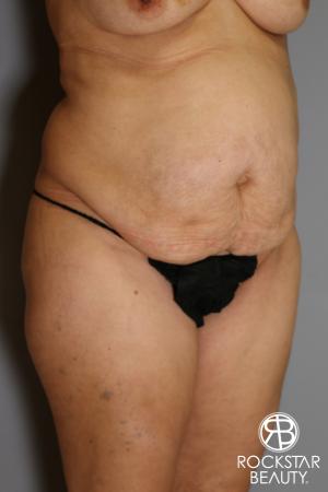 Tummy Tuck: Patient 13 - Before Image 2
