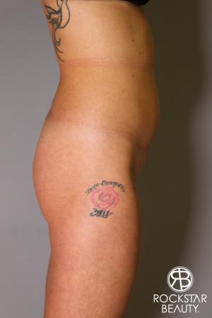 Brazilian Butt Lift: Patient 6 - Before Image 4