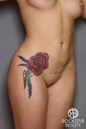 Brazilian Butt Lift: Patient 18 - After Image 5