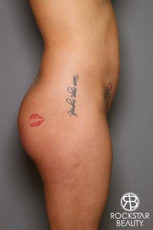Brazilian Butt Lift: Patient 17 - Before Image 4
