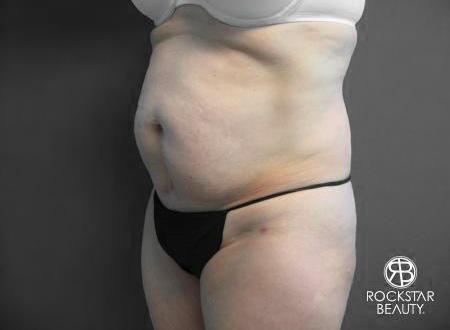 Tummy Tuck: Patient 6 - Before 3