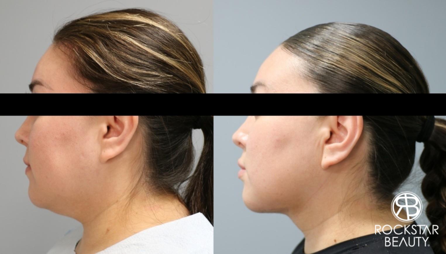 Liposuction Of The Neck: Patient 11 - Before and After 1