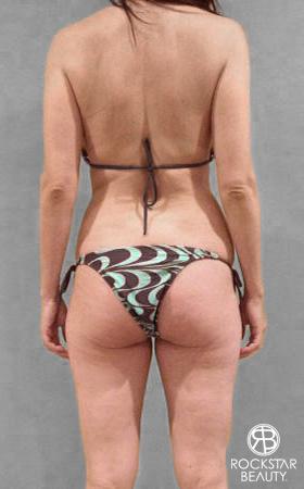Liposuction: Patient 8 - Before and After 3