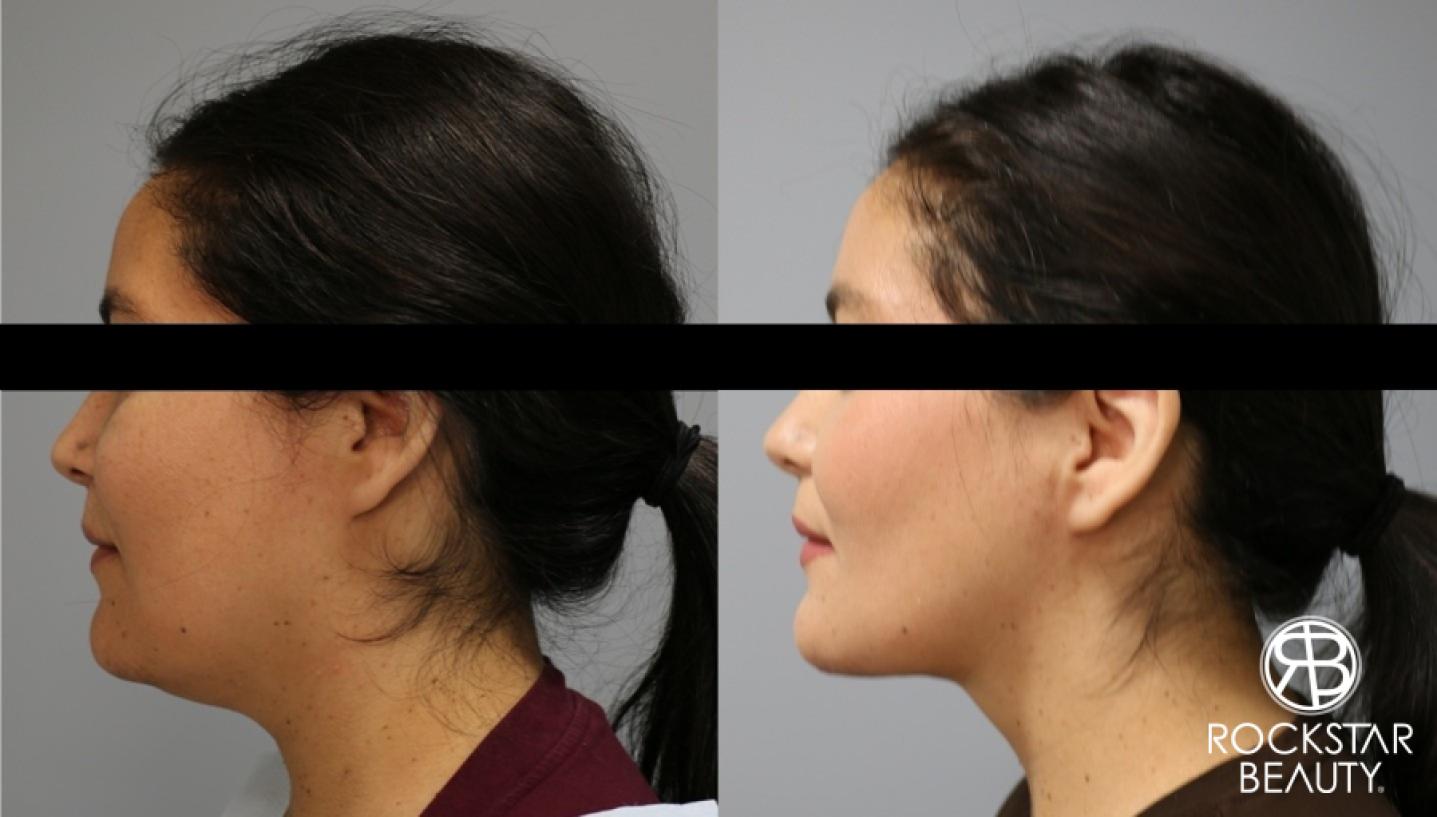 Liposuction Of The Neck: Patient 12 - Before and After 1