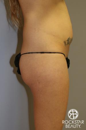 Liposuction: Patient 2 - Before Image 2