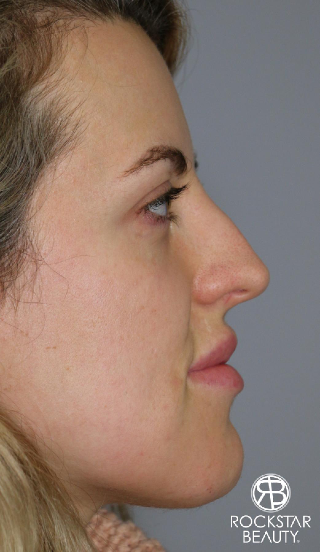 Rhinoplasty: Patient 1 - Before 2