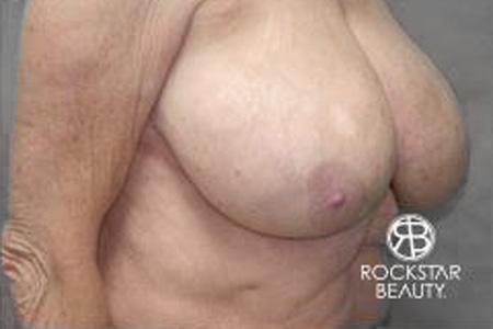 Breast Reduction: Patient 2 - Before 2
