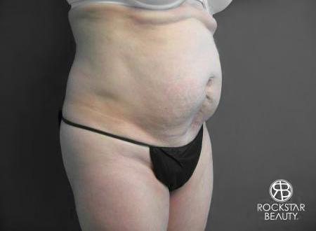 Tummy Tuck: Patient 6 - Before 2