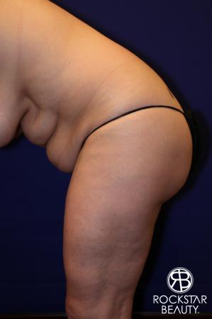 Tummy Tuck: Patient 12 - Before Image 4