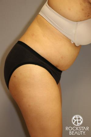 Tummy Tuck: Patient 2 - After Image 4