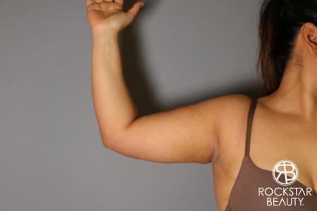 Liposuction: Patient 12 - After Image 1