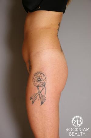 Brazilian Butt Lift: Patient 6 - Before and After Image 5