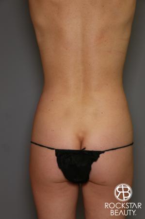 Liposuction: Patient 13 - Before and After Image 4