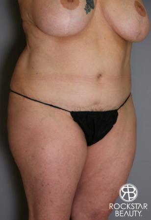 Tummy Tuck: Patient 12 - After Image 3