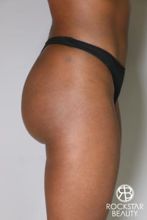 Butt Augmentation: Patient 2 - Before Image 3