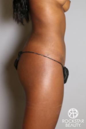 Liposuction: Patient 19 - After Image 4