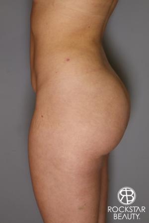 Brazilian Butt Lift: Patient 18 - After Image 2