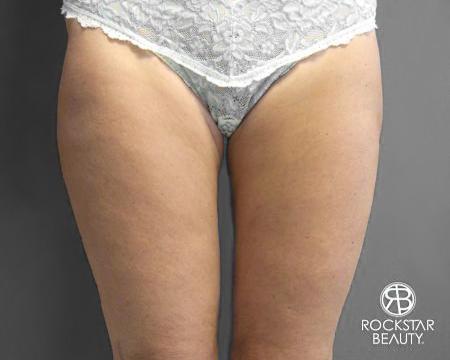 SmartLipo®: Patient 4 - After 1