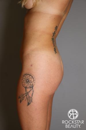 Brazilian Butt Lift: Patient 6 - After Image 5