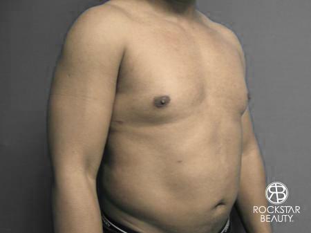 Liposuction: Patient 10 - After 2