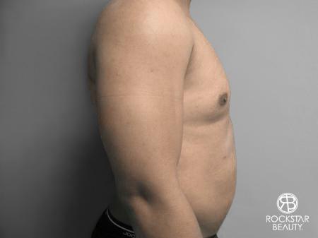 Liposuction: Patient 10 - After 3