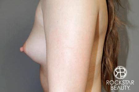 Breast Augmentation: Patient 6 - Before and After 5